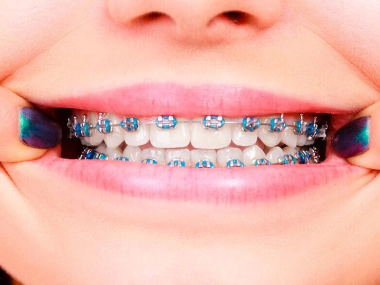 treatment-braces