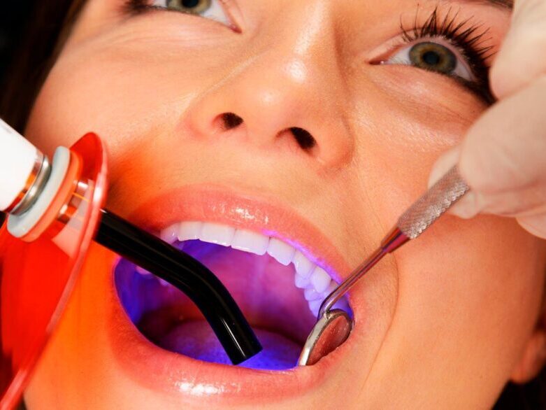 treatment-fillings