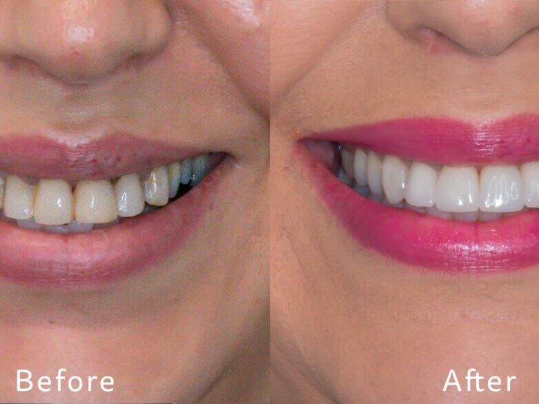 treatment-smilemakeover