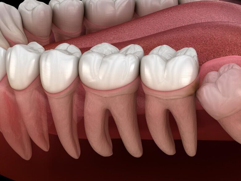 treatment-wisdomteeth