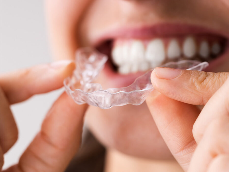 clear change aligners