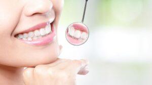 Teeth Whitening