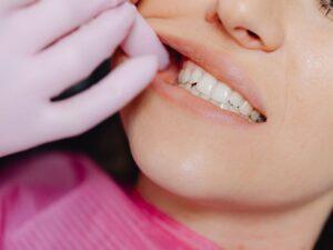 Wisdom Teeth Removal