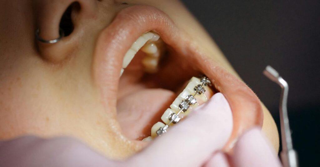 Braces