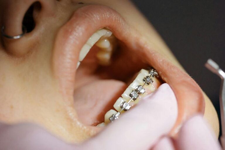 Braces
