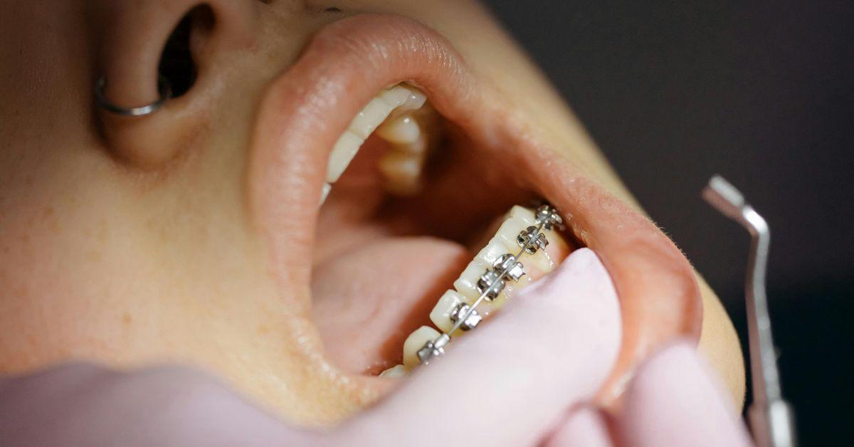 What Foods Are Safe to Eat with Dental Braces Braces