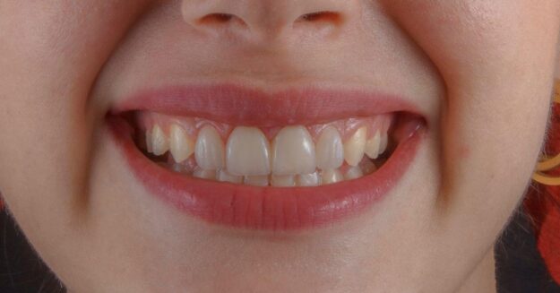 How Does a Dentist Decide to Remove a Tooth?