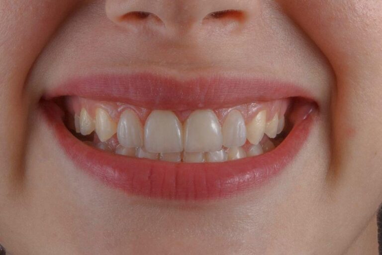 How Does a Dentist Decide to Remove a Tooth?