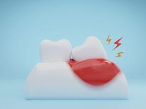 Wisdom Teeth Removal