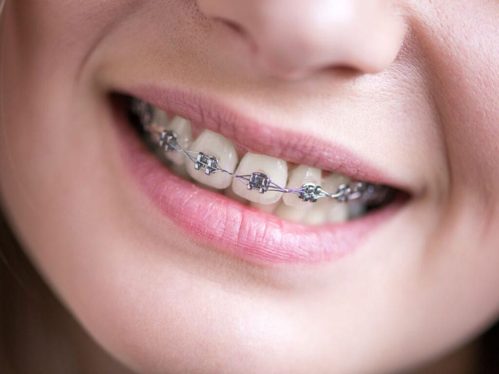 Braces