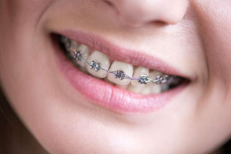 Braces