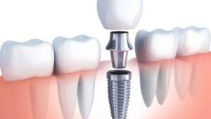 Dental Implant