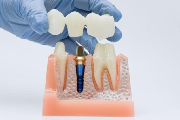 Dental Crown