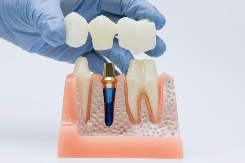 Dental Crown
